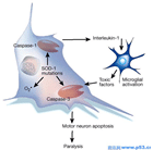 运动神经元病治疗