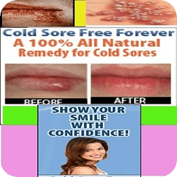 Cold Sores