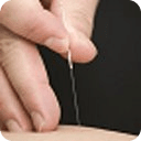 Acupuncture For Migraines