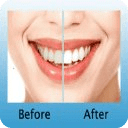 Teeth Whitening DIY